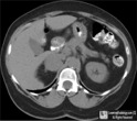 pheochromocytoma